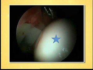 The CORE Institute treats hip pain with arthroscopy