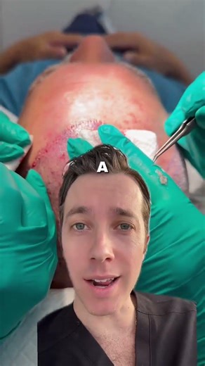 Why Every Hair Transplant Graft Matters