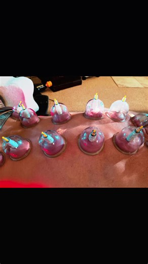 anybody else bleed when cupping
