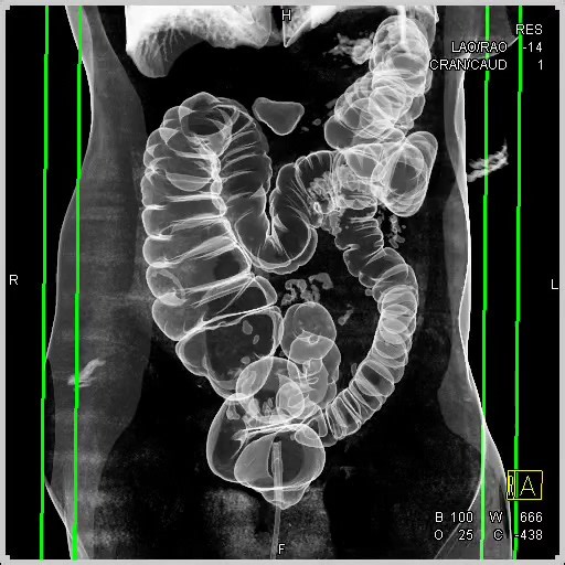 CTisus | Dr. Elliot K Fishman on Instagram: "Virtual Colon"