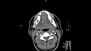 3d Ct Scan Paranasal Sinuses Sinusitis Stock Footage Video (100% Royalty-free) 3821093851 | Shutterstock
