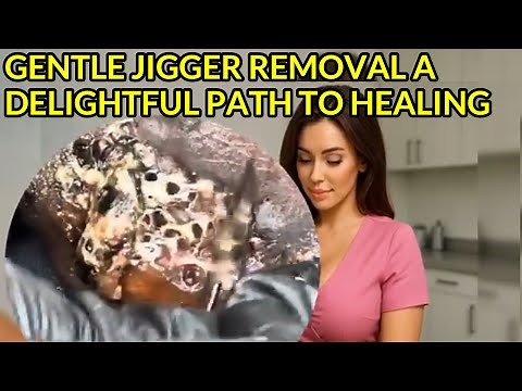 Gentle Jigger Removal | A Delightful Path to Healing