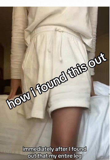 My Hemipelvectomy Amputation Experience: A Personal Story