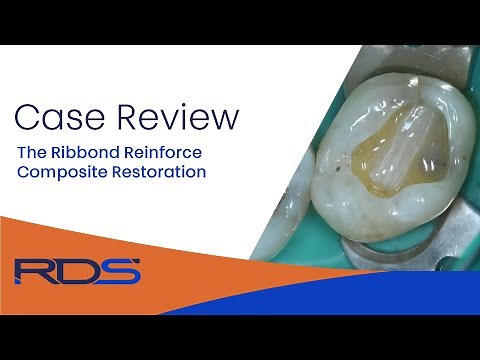 The Ribbond fiber reinforce composite restoration