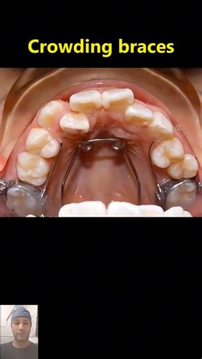Braces timelapse. Fix crowding teeth #braces #dentist #orthodontist #teeth #dental