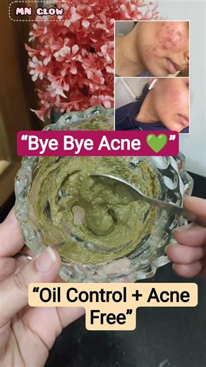 Day 3 Oily Skin & Acne? Try This Magic DIY Mask 😍Acne se chutkaara aur oil control ek sath 😍