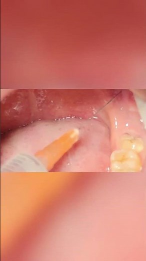 How to avoid root breakage during extraction? #dentist #teethdecay
