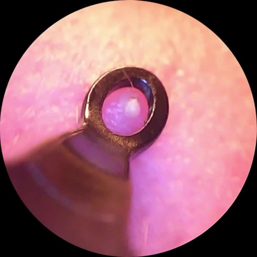 Satisfying whitehead removal #acne #pimple #blackhead #clean #extractions #satisfying #foryou