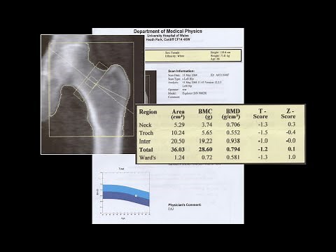 Understanding a DXA scan