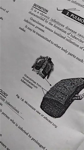 TB Pathophysiology Explained in Easy Language