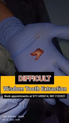 Difficult Wisdom Tooth Extraction done without Pain; Dr. Srishti Bhatia #dentist #nopain