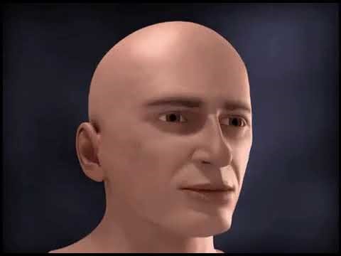 Hemorragia no cérebro // Aneurisma Meme