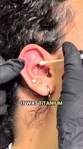 Daith piercing bump healed clean with Base Labs Bump Treatment + HOCl Spray. #piercingaftercare