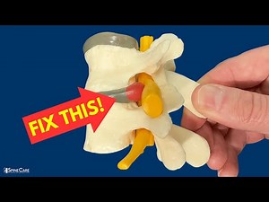 How to Relieve Herniated Disc Pain in SECONDS