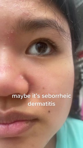 Managing Seborrheic Dermatitis: Effective Skincare Routine Tips