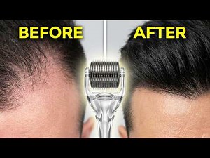 Dermarolling for Hair Growth: The Only 3 Steps You Need