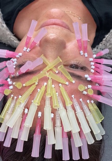 Smooth Threads are one of our favorite treatments to tighten, lift, and rejuvenate the skin. This minimally invasive procedure helps stimulate natural collagen production, restoring firmness and improving skin texture over time. It’s the perfect way to enhance your natural contours and achieve a smoother, more youthful appearance — no surgery, just results that build from within. Have you tried Smooth Threads yet? Let us know what you think below. #SmoothThreads #CollagenBoost #SkinTightening #Y