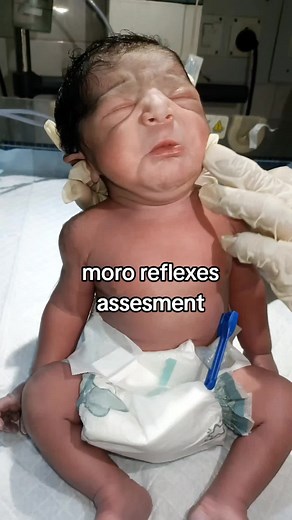 Understanding Moro Reflexes in NICU Babies