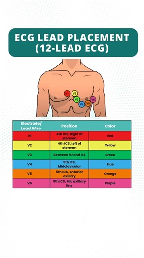 eNursing | DHA, DOH, MOH, SNLE, NHRA, QCHP and OMSB exam Prep on Instagram: "Understanding 12-lead ECG lead placement is critical for accurate heart monitoring and diagnosis. Each lead offers a unique view of the heart’s electrical activity, helping detect arrhythmias, myocardial infarctions, and conduction abnormalities. In Prometric exams like DHA, MOH, QCHP, OMSB, and HAAD, nurses are frequently tested on correct lead placement to assess their clinical readiness. Misplacement can lead to inco