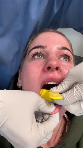 Cause my last video blew up, heres a fail one where the moulds harded instantly #jawsurgery #underbite #braces #moulds #dental #dentist #nz #dentis #underbitecheck #1111 #doublejawsurgery #fyp #foryou #viral #tiktok #trending #onfyoupage #brackets #teeth #hi #braceface #trending #dentalhygienist #orthodontist