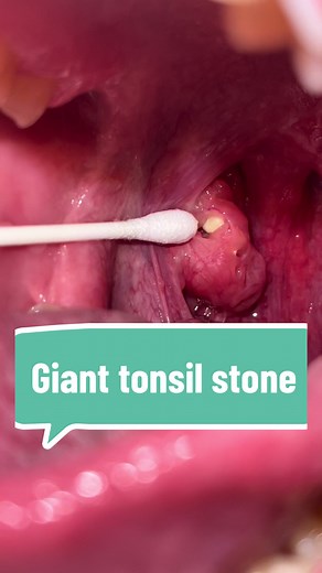 Look at this huge tonsil stone! #tonsilstones #tonsilstonesremoval #satisfying