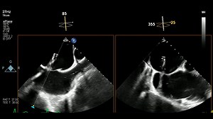 Guide Positioning of the Delivery System to the Mitral Valve - M-TEER