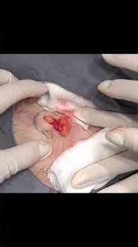 Multiple Lipomas Removed in One Pop Party