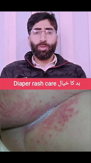 23K views · 426 reactions | Care of diaper area and rash in Urdu. Full video link in comment... | Dr Mir Ajaz Health Tips | Facebook