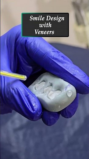 Smile Design with Veneers & Process: See the Transformation to a Perfect Smile!