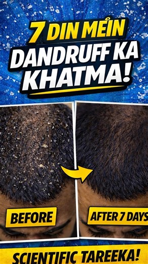 Dandruff Ko 7 Din Mein Kaise Khatam Kare
