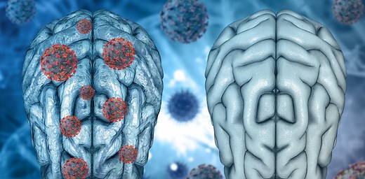 Even mild cases of COVID-19 can leave a mark on the brain, such as reductions in gray matter – a neuroscientist explains emerging research