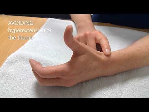 Osteoarthritis of carpometacarpal Thumb joint