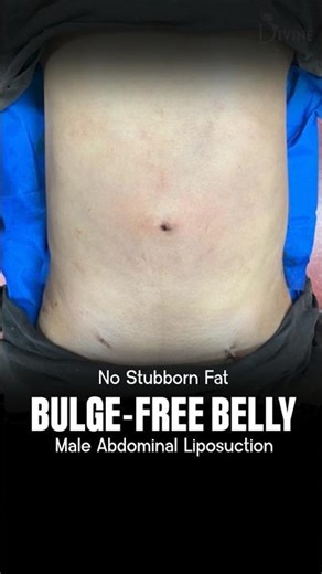 Advanced Abdominal Liposuction for Stubborn Belly Fat & Better Body Contour