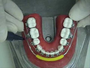 Confecção da PLA (Placa Lábio Ativa)