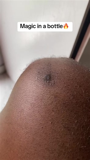 Effective Scar Removal Techniques for Clear Skin