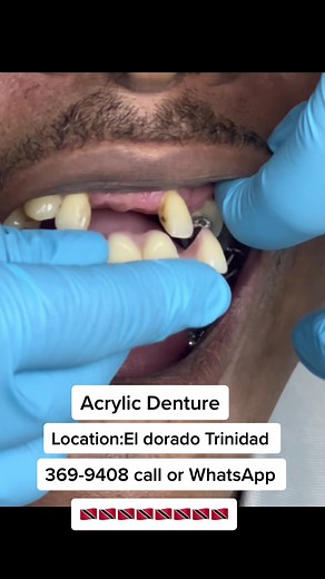 Acrylic Dentures are affordable and very functional allowing you to replace teeth and eat food comfortably 🥰🦷 #dentist #trinidaddentist #snapindentures #teethreplacement #acrylicdenture #flexibledenture #flipperdenture #dentalbridge #implants #missingtooth #toothremoval #veneers #dentalimplants