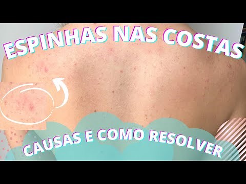 ESPINHAS NAS COSTAS * como tratar e causas* - Bruna Harmel