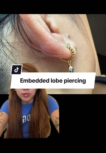 Embedded Lobe Piercing: What You Need to Know