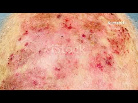 Tinea Infection: Causes, Symptoms, Treatment & Prevention | Fungal Skin Infections Explained”