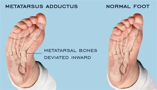 dr.sibcawilliam on Instagram: "●Metatarsus adductus, also known as metatarsus varus, is a common foot deformity that causes the front half of the foot, or forefoot, to turn inward. The deformity is typically visible at birth. ●May be "flexible" (the foot can be straightened to a degree by hand) or "non-flexible" (the foot cannot be straightened by hand). ●Occurs in about one of every 1,000 to 2,000 live births. ●Babies with metatarsus adductus are at an increased risk for developmental dysplasia