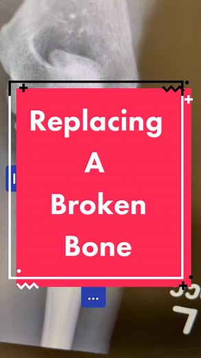 Elbow replacement. #surgery #medtiktok #pa #premed #elbow