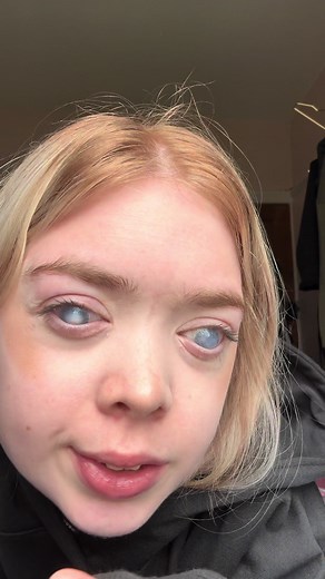 My Journey of Living with Blindness for 10 Years