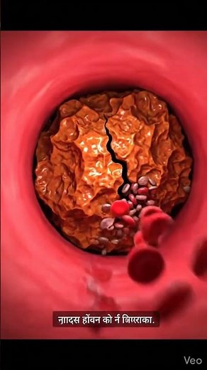 How Blocked Arteries Cause High Blood Pressure | Medical Animation