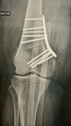 genou valgum osteotomie femorale de varisation