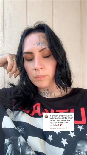 nope we’re all blessed with both active demyelination and atrophied lesions #keepsmyelin #ms #multiplesclerosis#msawareness #multiplesclerosisawareness #multiplesclerosiseducation #mseducation #livingwithmultiplesclerosis #disability #demyelinatingdisease | Kiel Harris