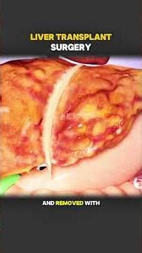 How Liver Transplant Surgery Is Performed (3D Animation) #medicaleducation #healthcare #fyp