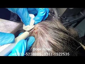 Scalp Wart Removal Treatment ✨