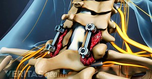 Cervical Laminectomy Video