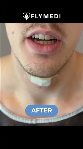 Voice Masculinization #beforeandafter