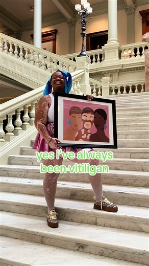 Embracing Vitiligo: A Journey to Self-Acceptance